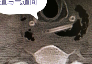 男子脖子肿痛三天，元凶竟是鸡骨头卡喉